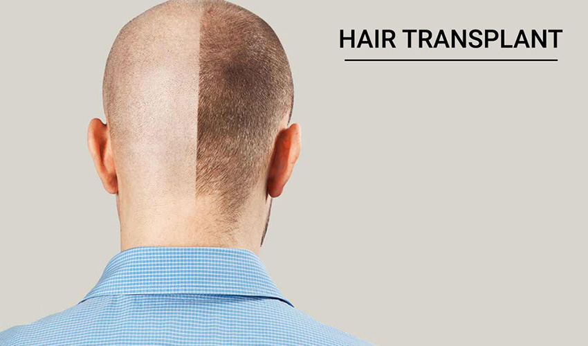 Hair-Transplant-in-Udaipur